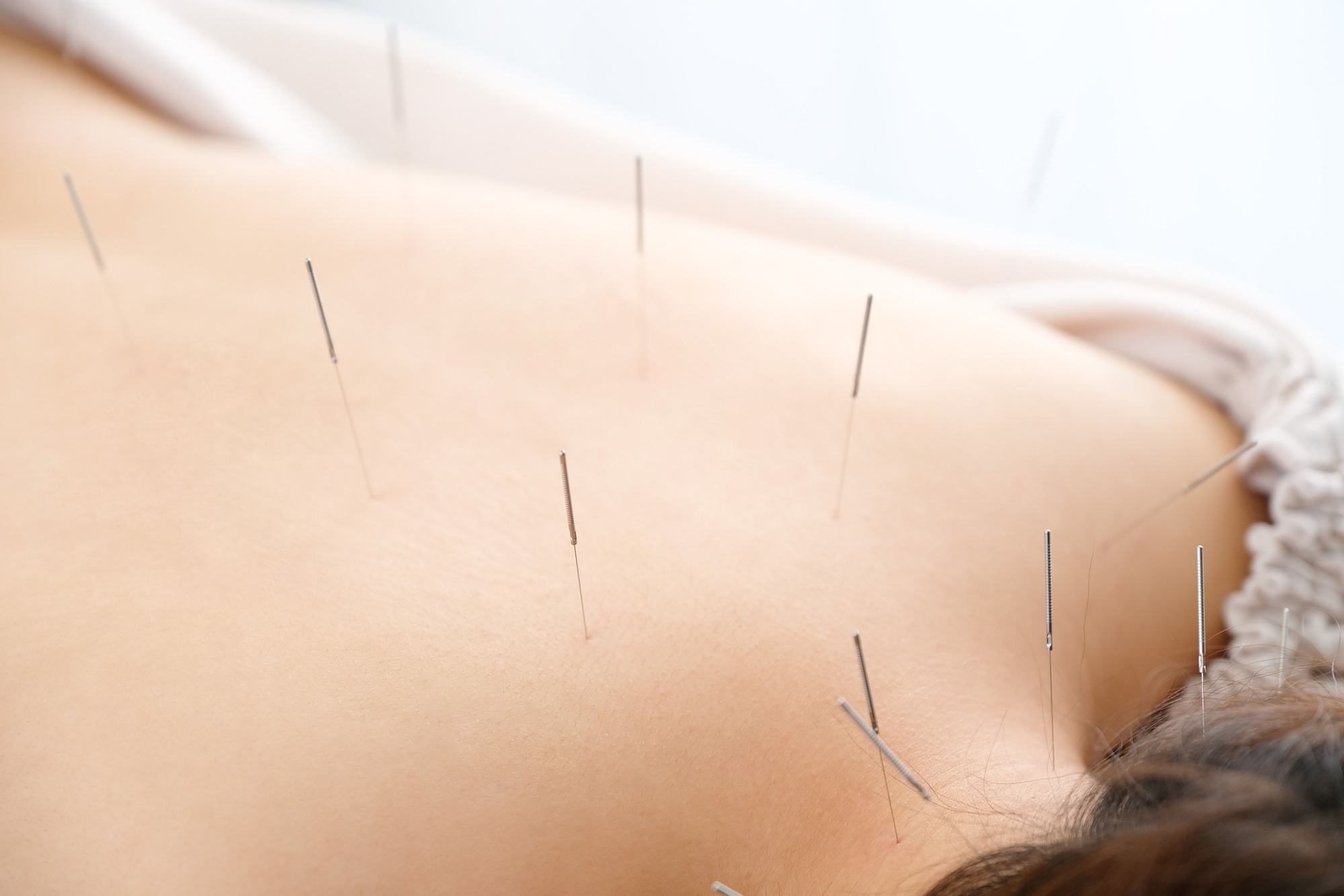 A woman with a needle stuck to her back at a bright acupuncture clinic